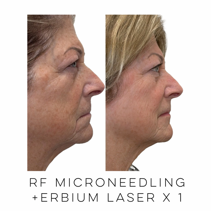 Profile view of a patient before and after RF microneedling combined with Erbium laser resurfacing demonstrating smoother skin, improved texture, and a more even complexion at Skin Treats Aesthetics in Louisville, KY.
