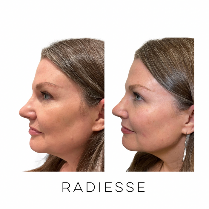 Profile view of patient before and after Radiesse treatment to restore facial volume and improve skin quality at Skin Treats Aesthetics in Louisville, KY.