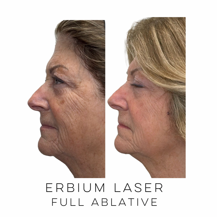 Left profile view of a patient before and after full ablative Erbium laser resurfacing showing smoother skin and improved overall skin quality at Skin Treats Aesthetics in Louisville, KY.