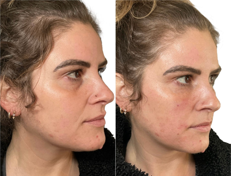 Three-quarter view of patient before and after showing natural facial rejuvenation with Cellenis Derma Biofiller at Skin Treats Aesthetics in Louisville, KY.