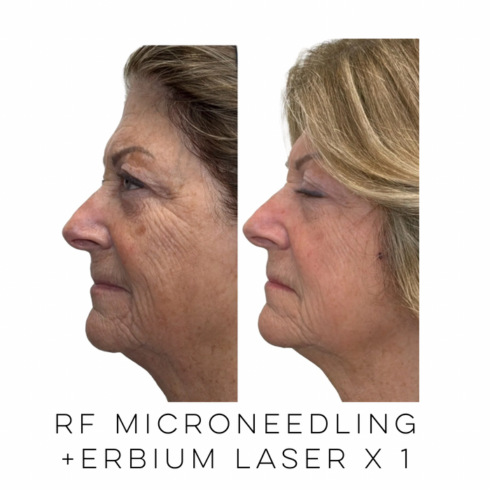 Side profile of a patient before and after RF microneedling combined with Erbium laser resurfacing showing healthier-looking skin, improved texture, and natural-looking rejuvenation at Skin Treats Aesthetics in Louisville, KY.