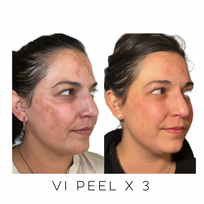 Three-quarter view of a patient before and after three VI Chemical Peel treatments demonstrating brighter skin, improved skin tone, and reduced hyperpigmentation at Skin Treats Aesthetics in Louisville, KY.
