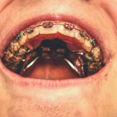 מכשירים אוראלים