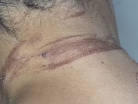 Mulher Denuncia Ter Sido Estrangulada e Enterrada Viva Pelo Ex-Namorado na Bahia.