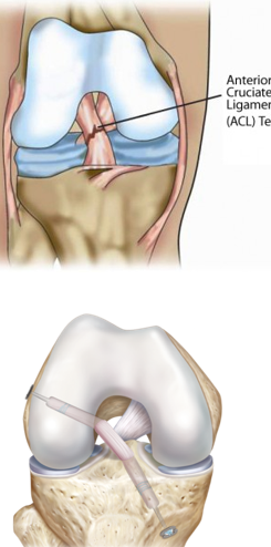 ACL.PNG