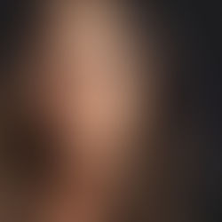 Queda de cabelo: o sintoma inusitado da Covid-19