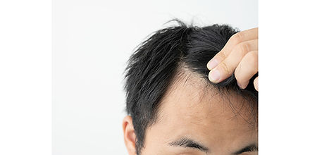 AGA(男性型脱毛)
