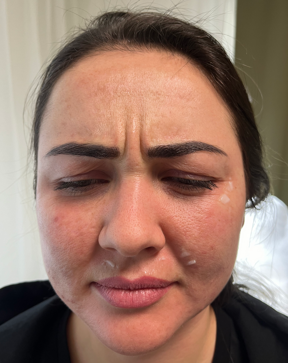 Before neurotoxin treatments in glabella area (11 lines)
