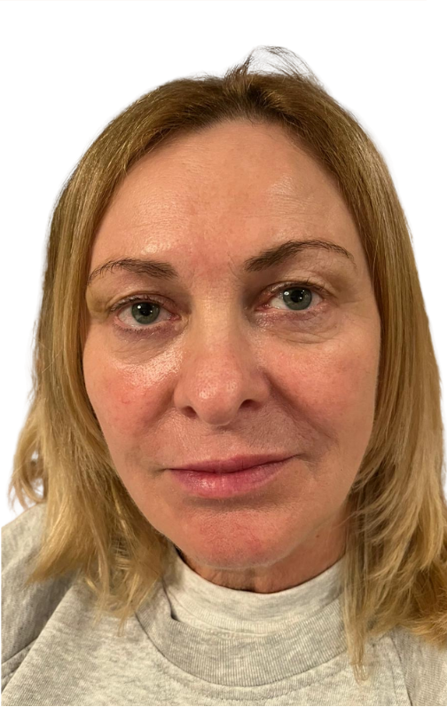After combined procedure results
