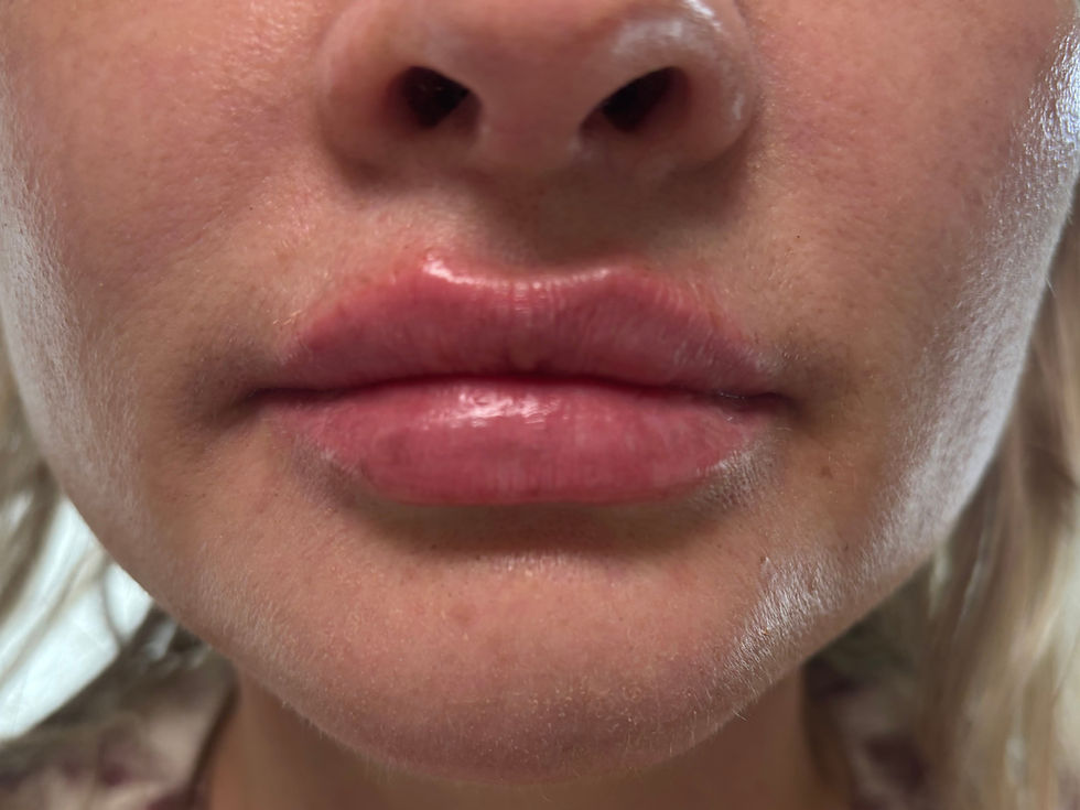 After lip augmentation treatment
