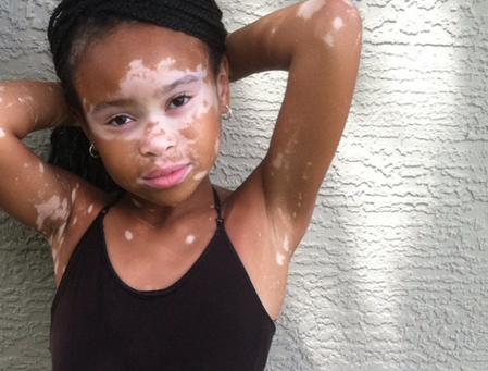 Vitiligo: Recupere sua autoestima e bem-estar!