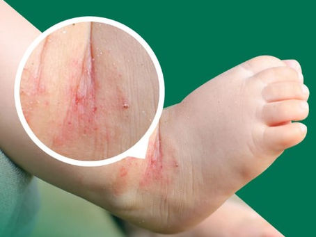 Alivie a coceira e devolva a alegria à pele do seu filho com o tratamento para eczema! 