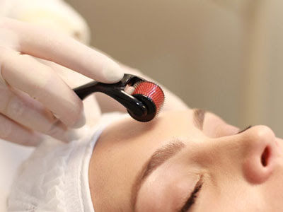 Microagulhamento: Rejuvenesça sua pele e alcance a perfeição!