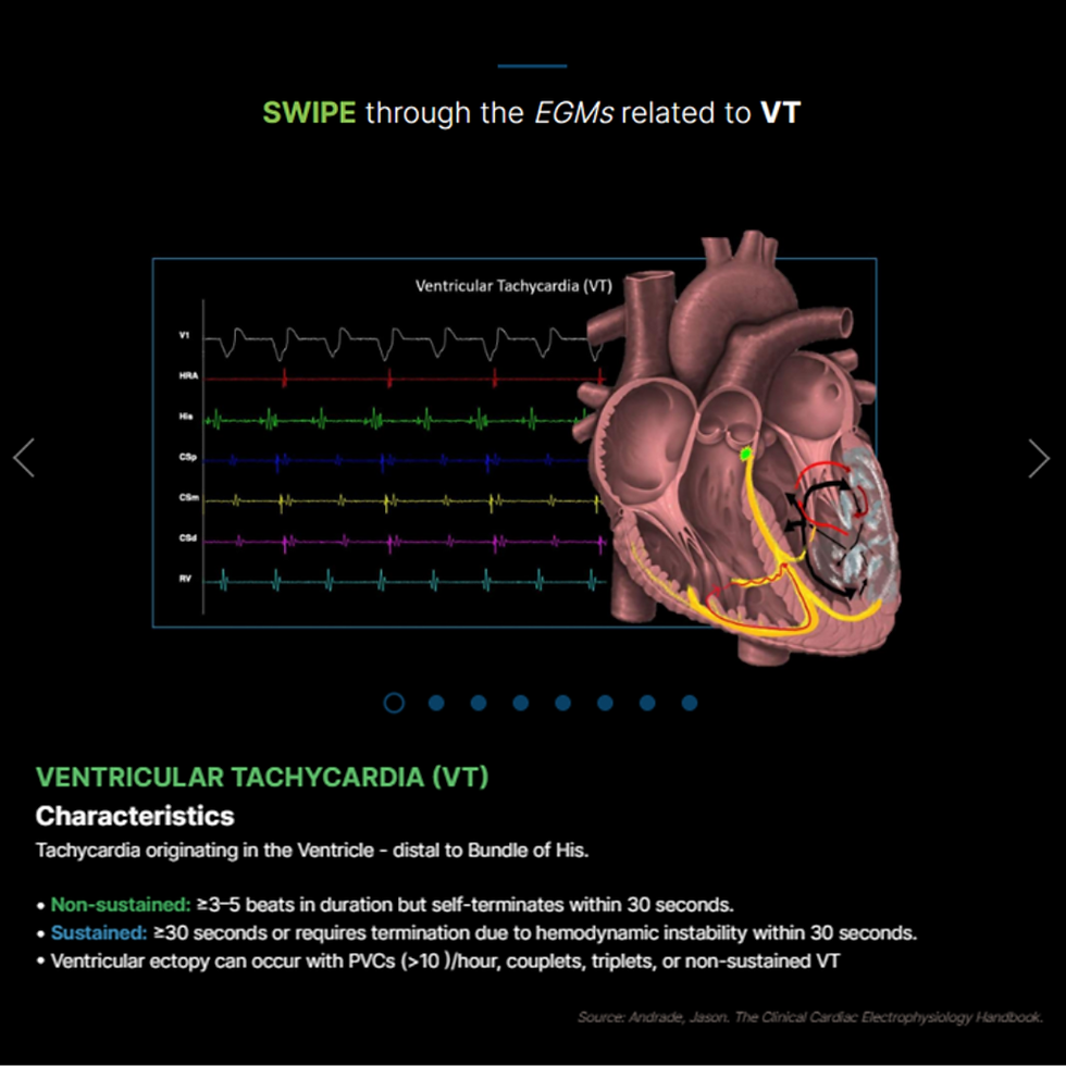 Thumbnail: Ventricular Tachycardia: The Rising Storm