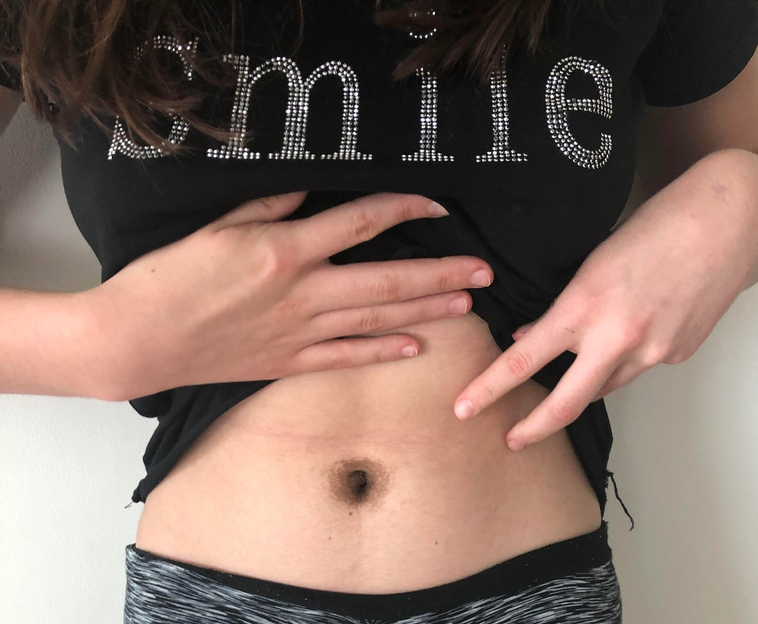 odtsranění pigmentu