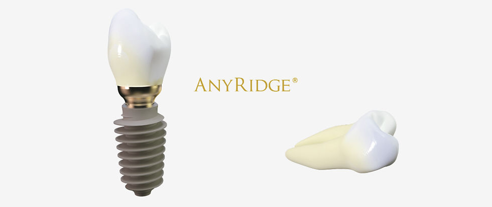 Thumbnail: AnyRidge Implant