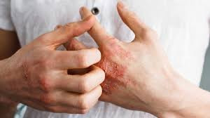 Scratching due to Eczema