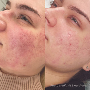 Rosacea Before and After Image Dermaforce 3D