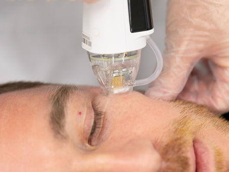 Dermaforce:  The new name in RF Microneedling, Stamford