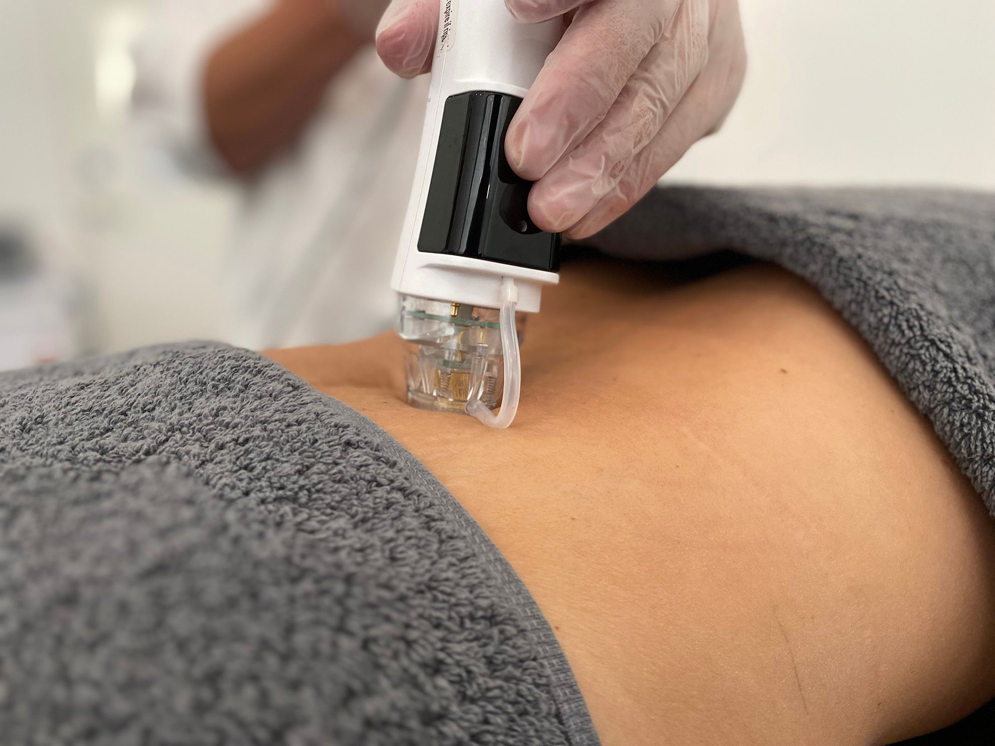 Microneedling with Radio Frequency