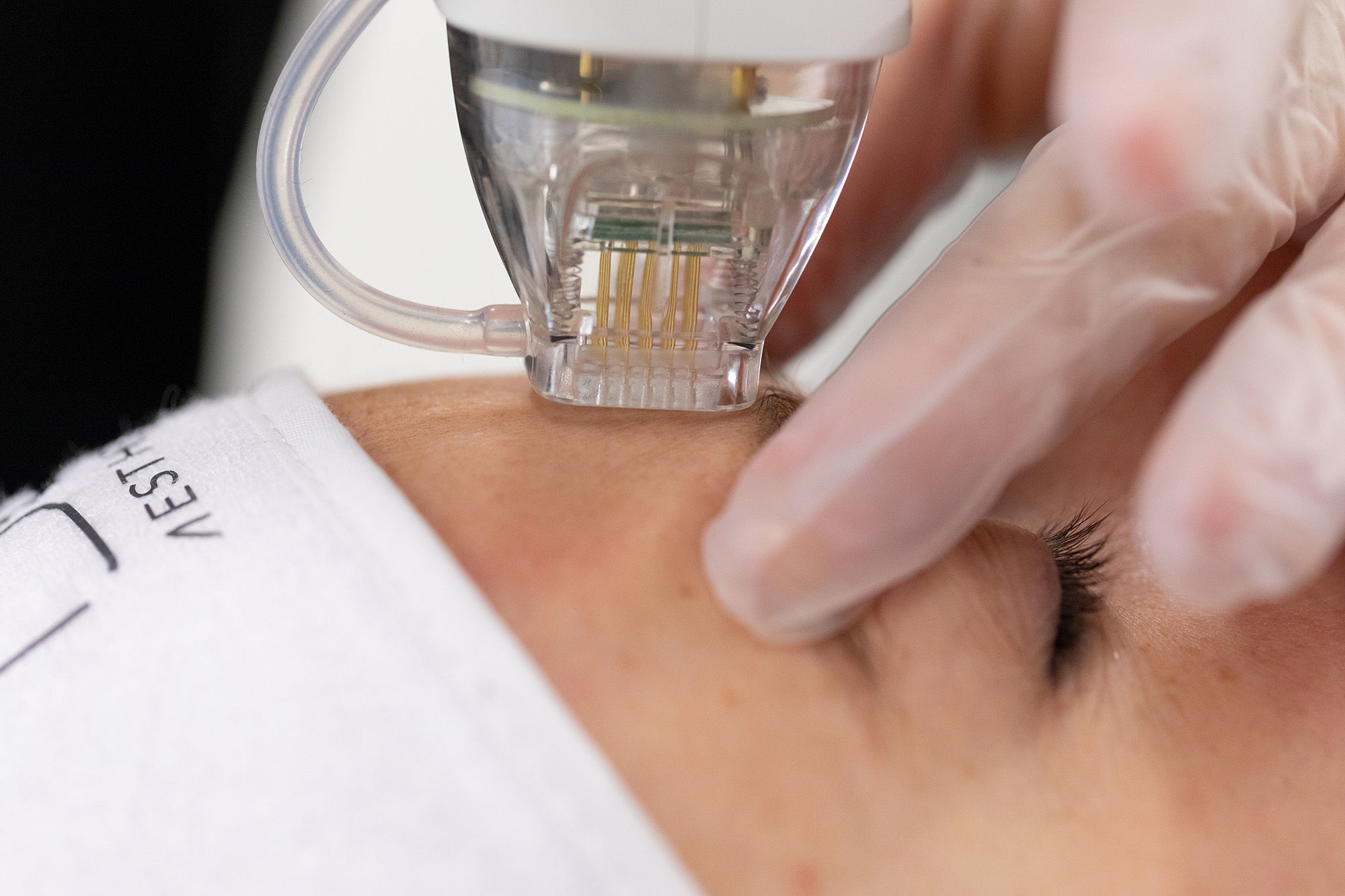Woman having a microneedling treatment