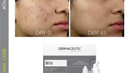 Dermaceutic Milk Peel | ALCEA Aesthetic and Wellness Centre  