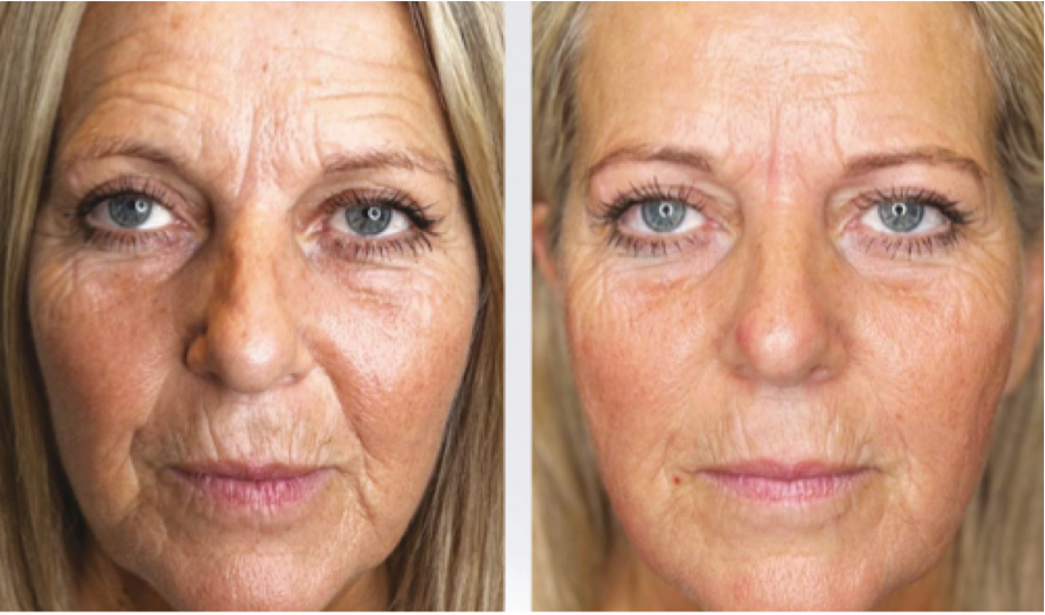 Before and after Hydro2 Facial with Radio Frequency
