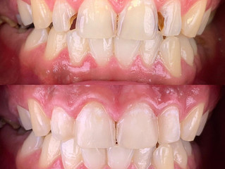Composite veneer