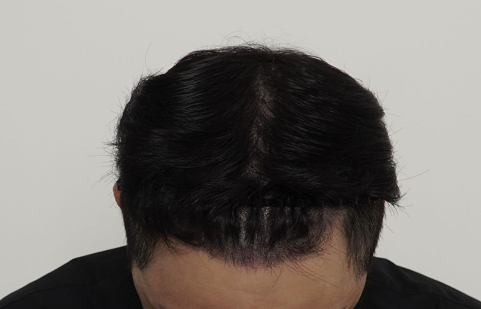 가발 벗고 두피문신 하기 전