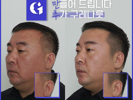 인천 두피문신 남성 탈모 커버 전후 사진