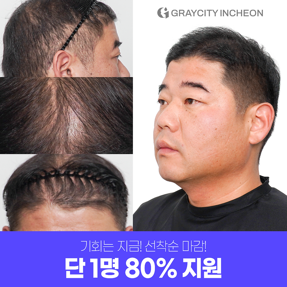 남성탈모