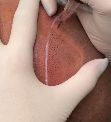 두피문신 흉터커버