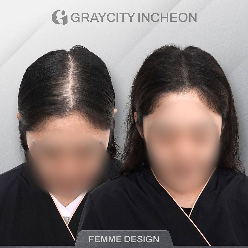 인천 여성 두피문신 정수리 사례