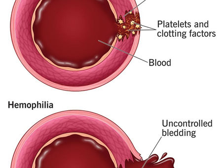 Hemophilia