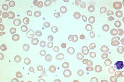 Iron-deficiency anemia