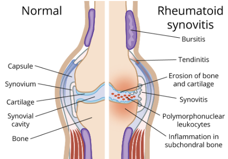 Rheumatoid Arthritis
