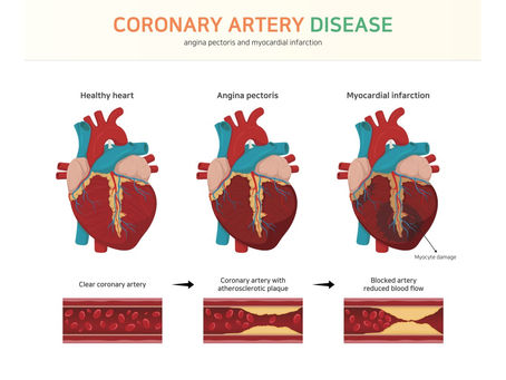 Coronary Artery Disease