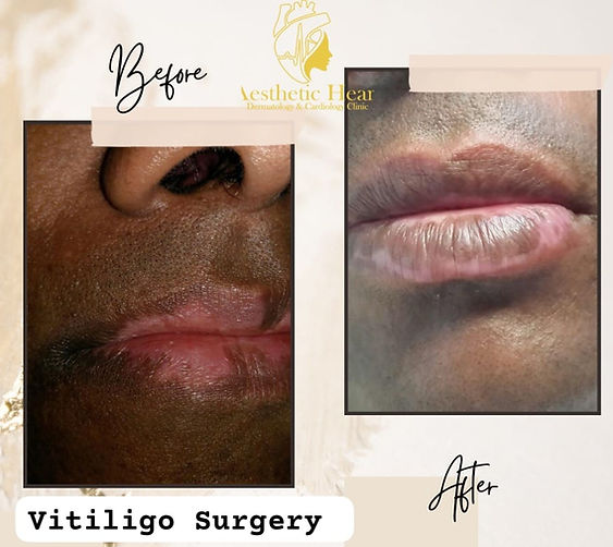 vitiligo surgery in bangalore
