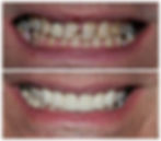 veneer-before-after-Santa-Rita-Dental