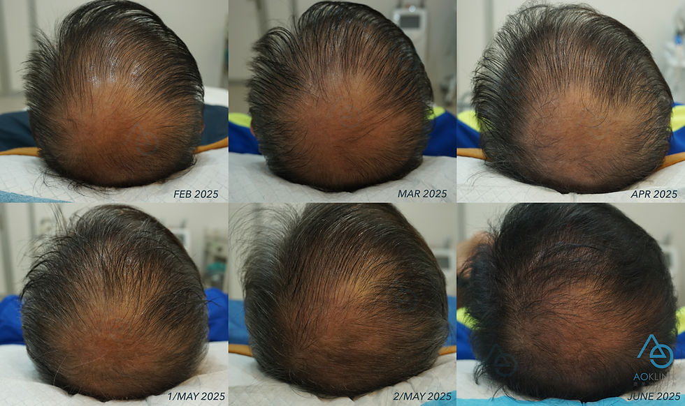 Hair Growth Before & After Comparison, AOKLINIK Penang