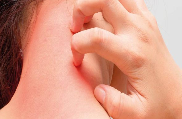 Como saber se a alergia é proveniente do calor, e como tratá-la: