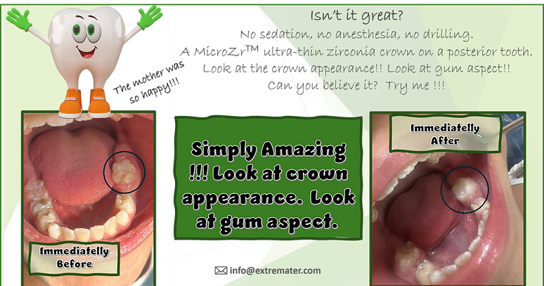 zirconia on posterior tooth.png