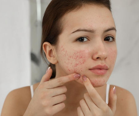 È SBAGLIATO SCHIACCIARE I BRUFOLI?