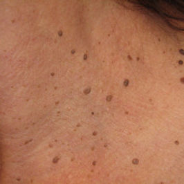 dermatosis papulosa nigra.jpeg