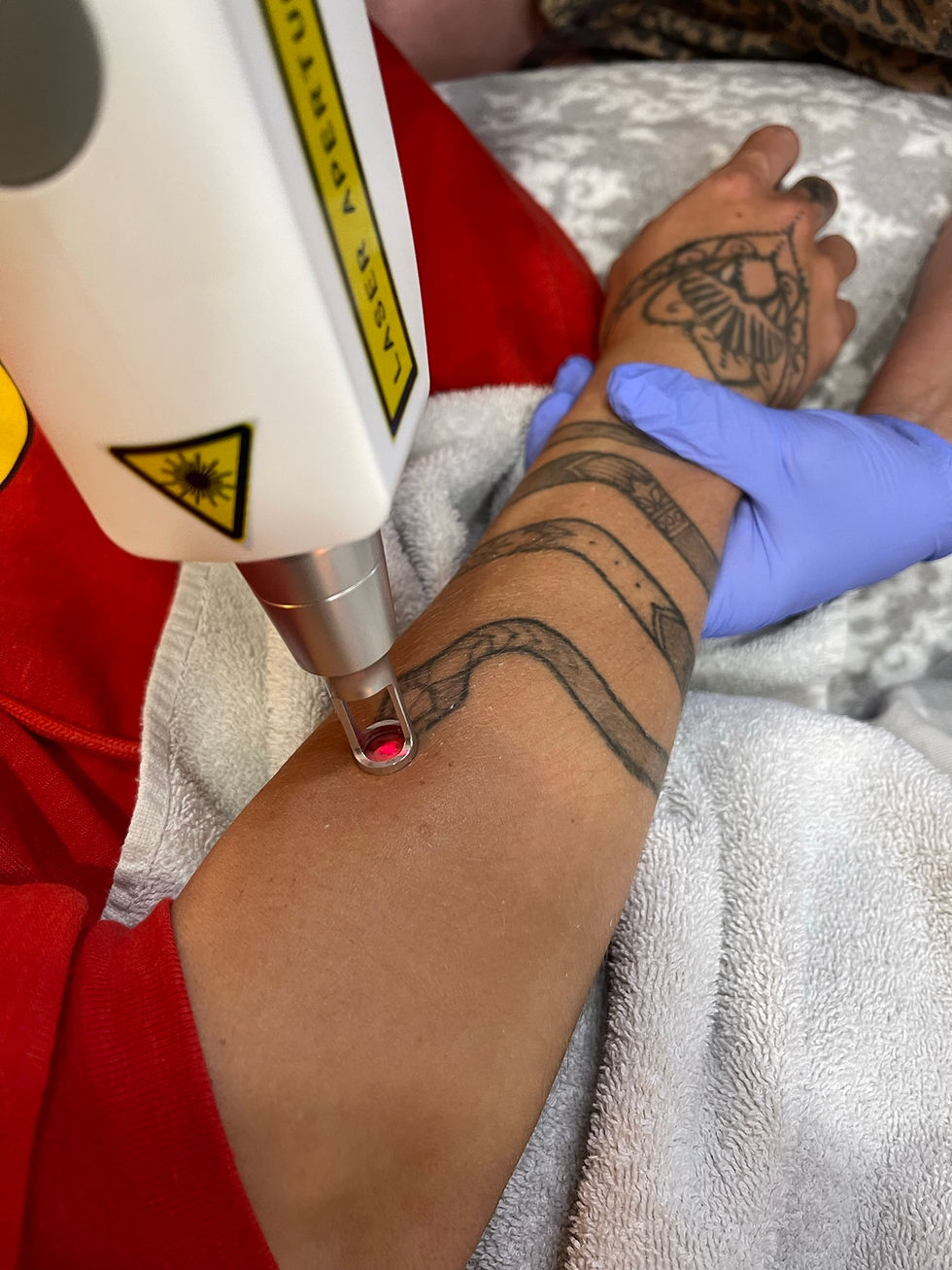 tattoo removal