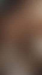 Ipermetropia: sintomi,cause