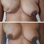 Reconstrução de Aréolas