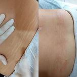 Tratamento de estrias na