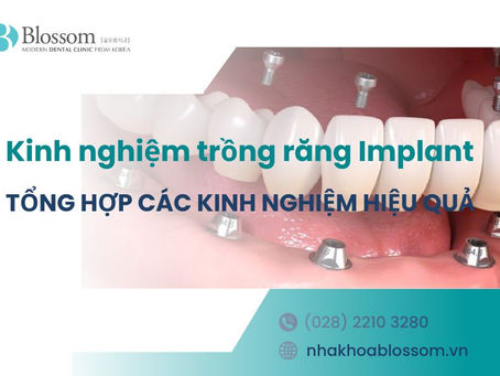 TỔNG HỢP 9 KINH NGHIỆM TRỒNG RĂNG IMPLANT HIỆU QUẢ