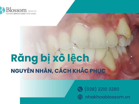 RĂNG BỊ XÔ LỆCH LÀ GÌ? NGUYÊN NHÂN VÀ CÁCH ĐIỀU TRỊ HIỆU QUẢ